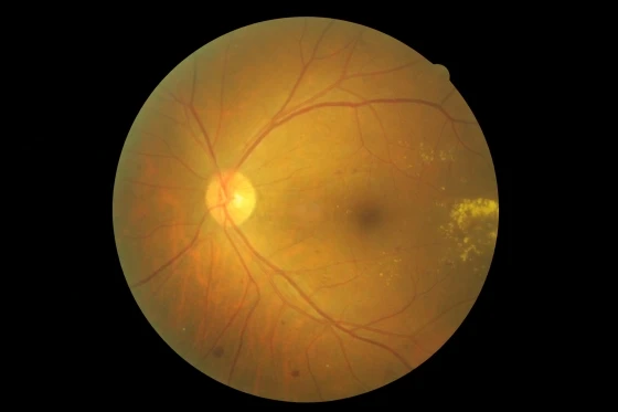 PPDR(增生前糖尿病視網膜病變)